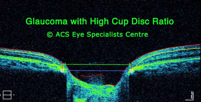 OCT Glaucoma